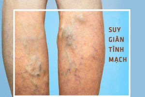 nhung-dieu-ban-can-biet-ve-benh-suy-gian-tinh-mach-chi-duoi