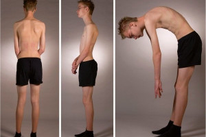 nhung-kien-thuc-ban-can-biet-ve-benh-gu-cot-song