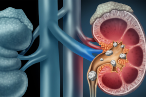 nhung-trieu-chung-canh-bao-som-tinh-trang-soi-than-va-cach-khac-phuc-hieu-qua