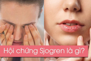 tim-hieu-nguyen-nhan-va-cach-dieu-tri-cua-hoi-chung-sjogren