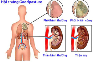 tim-hieu-ve-hoi-chung-goodpasture