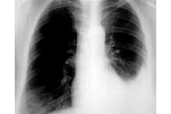 Tràn dịch màng phổi là gì? Có nguy hiểm không?