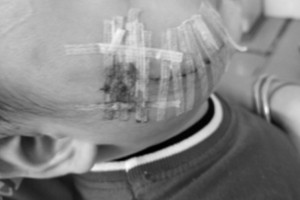 vap-phai-cho-nha-dang-ngu-be-2-tuoi-bi-can-rach-vung-mat