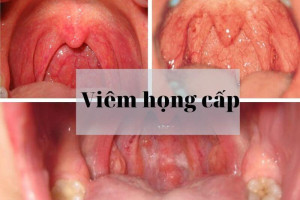 viem-hong-cap-la-gi-cach-chua-tri-dau-hong-tai-nha-an-toan