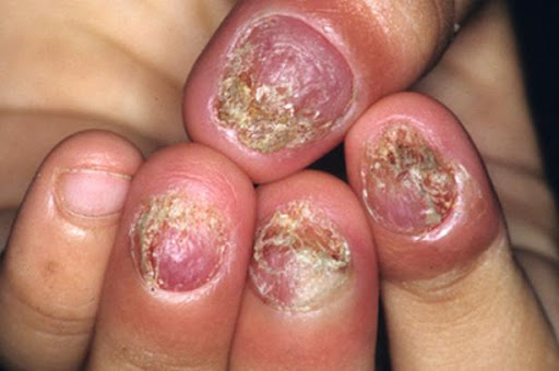 nhiem-trung-nam-mong