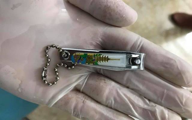 Bắt chước video trên youtube, bé 9 tuổi nuốt cả bấm móng tay vào bụng