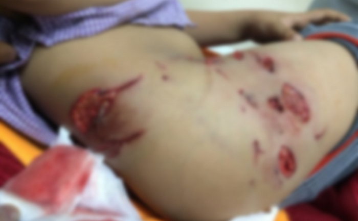 B&eacute; Đ. bị ch&oacute; cắn 30 vết thương