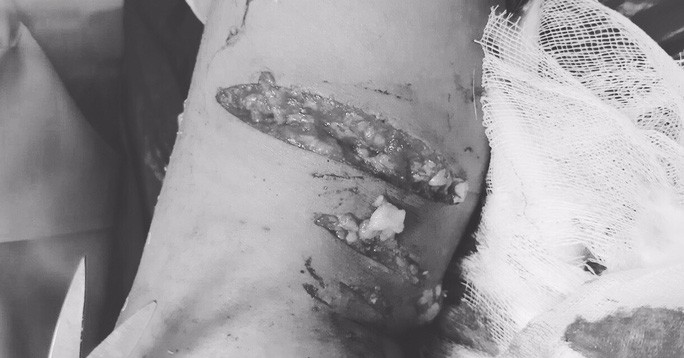 B&eacute; Đ. bị ch&oacute; cắn ghi&ecirc;m trọng nhất l&agrave; vết thương ở gối phải