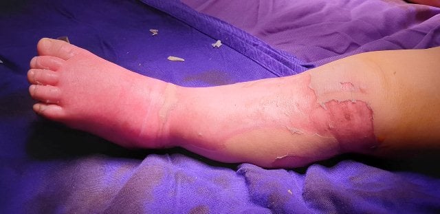 Bé 9 tháng tuổi tử vong vì gia đình đưa con đến thầy lang đắp thuốc chữa bỏng