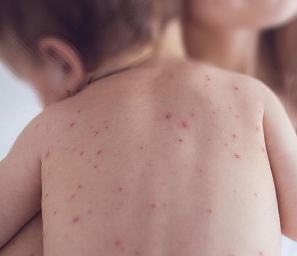Bé mới hơn 1 tuổi đã mắc sùi mào gà vì lây bệnh từ bố
