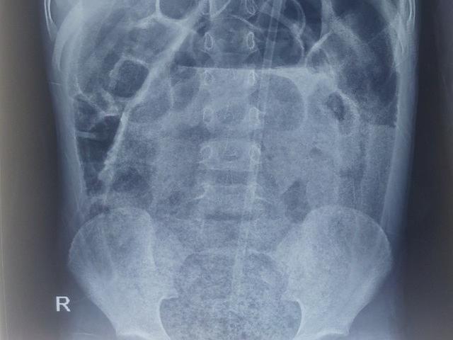 Bé trai 8 tuổi suýt vỡ ruột vì bị táo bón nhưng cha mẹ chủ quan