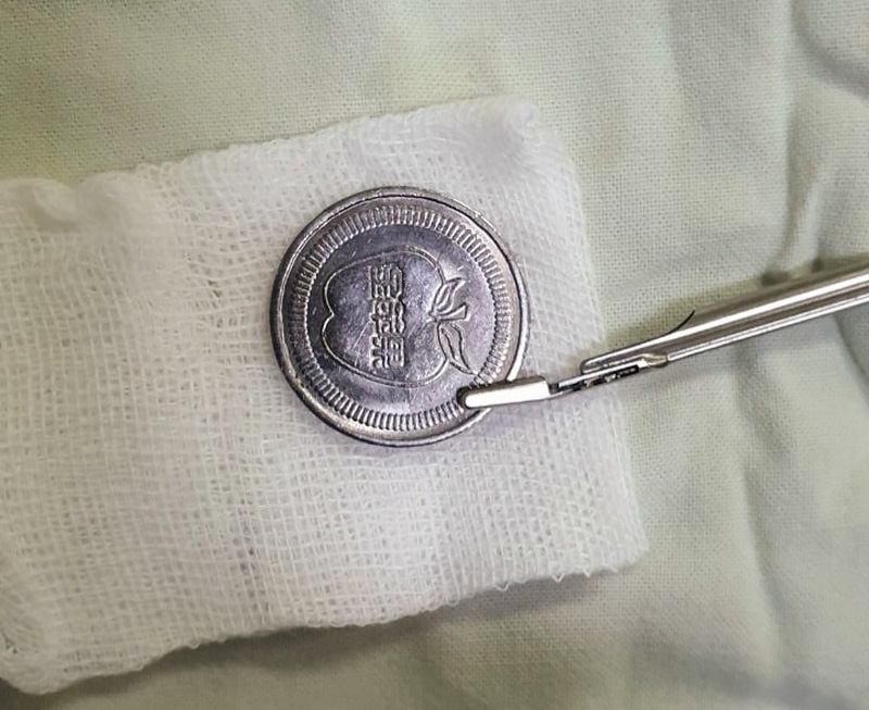 Bé trai hóc đồng xu, cha mẹ ghi nhớ ngay cách này để cứu con