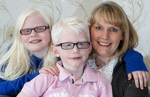 Bệnh bạch tạng di truyền từ cha mẹ sang con