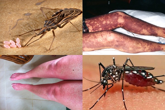 Bệnh Chagas sẽ khiến bạn bị sưng ở c&aacute;c nơi bị nhiễm tr&ugrave;ng 