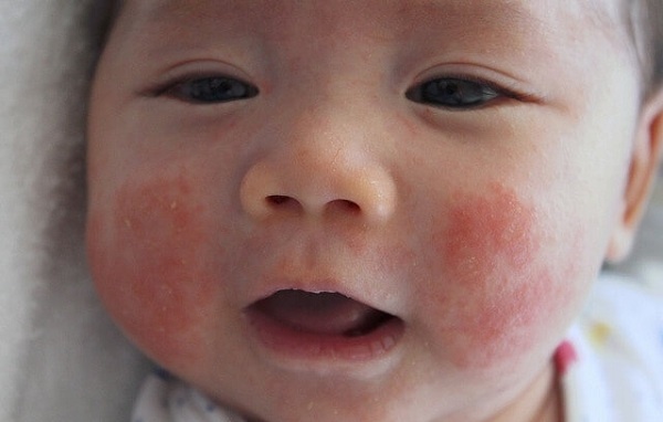 Bệnh Eczema ở trẻ em nguy hiểm như thế nào?