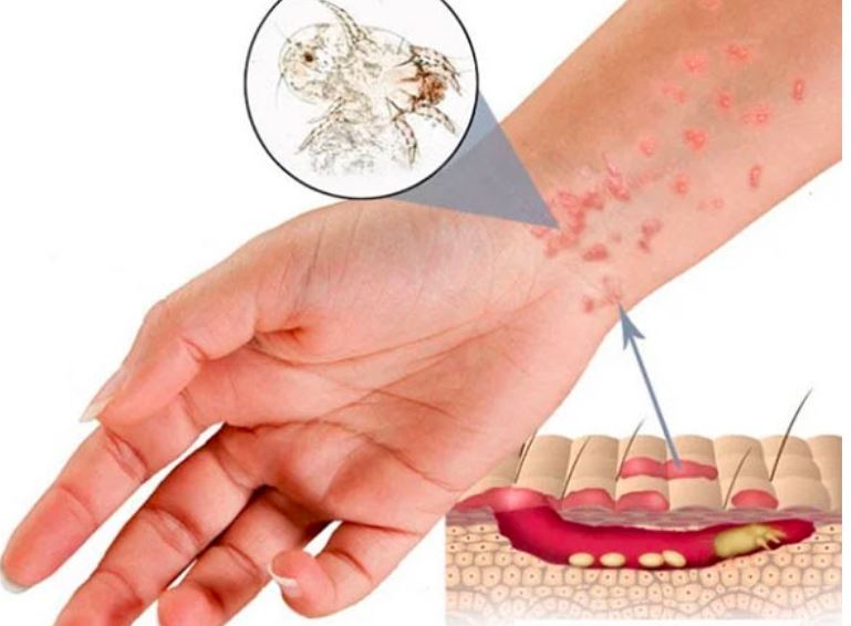 Bệnh ghẻ nước là gì? Các phương pháp điều trị dứt điểm bệnh ghẻ nước?