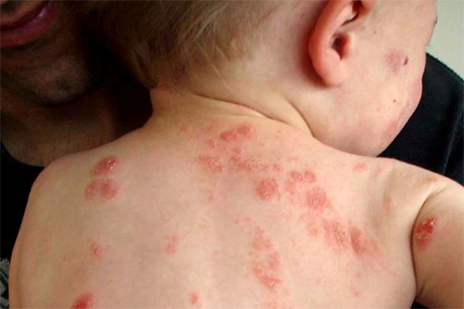 Bệnh giời leo: Triệu chứng và cách điều trị hiệu quả nhất