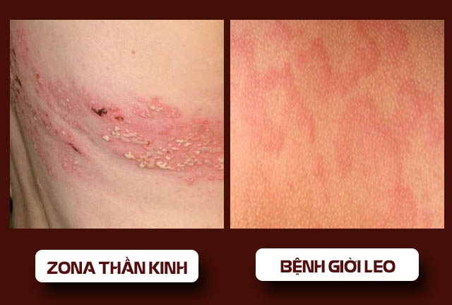 Bệnh giời leo hay zona do virus nhóm Herpes gây ra