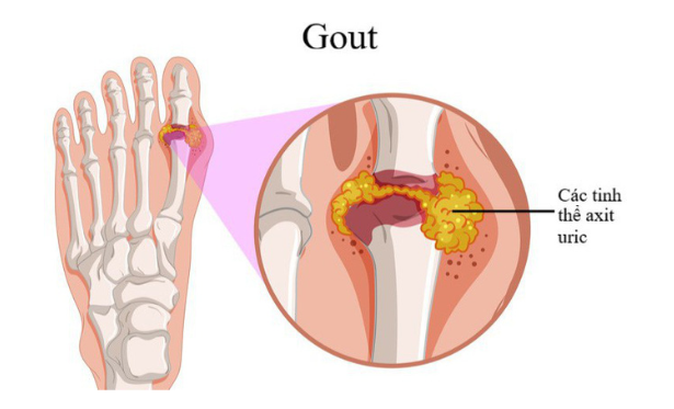 Bệnh gout: Nguyên nhân biểu hiện và cách điều trị