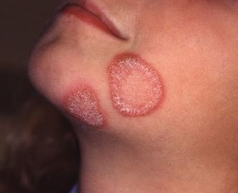 Bệnh hắc lào có lây nhiễm không? Cách chữa như thế nào?