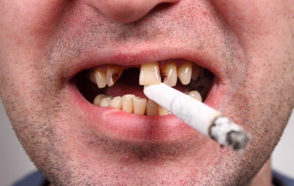Hút thuốc lá là nguyên nhân dẫn đến bệnh nha chu