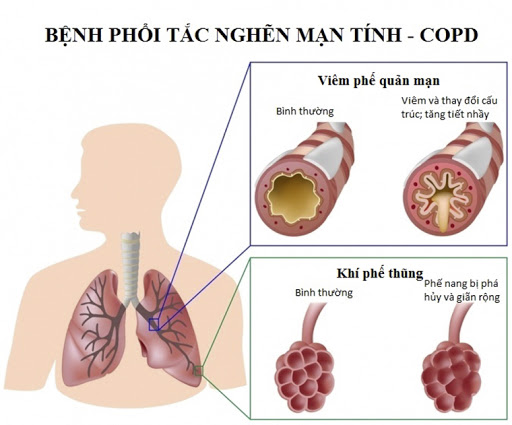 Bệnh Phổi tắc nghẽn mãn tính có nguy hiểm không? Sử dụng phương pháp nào trong điều trị bệnh?