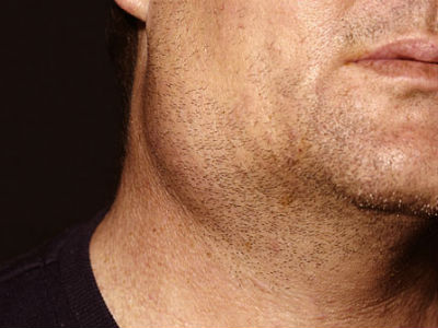 Bệnh quai bị là gì? Điều trị quai bị như thế nào?