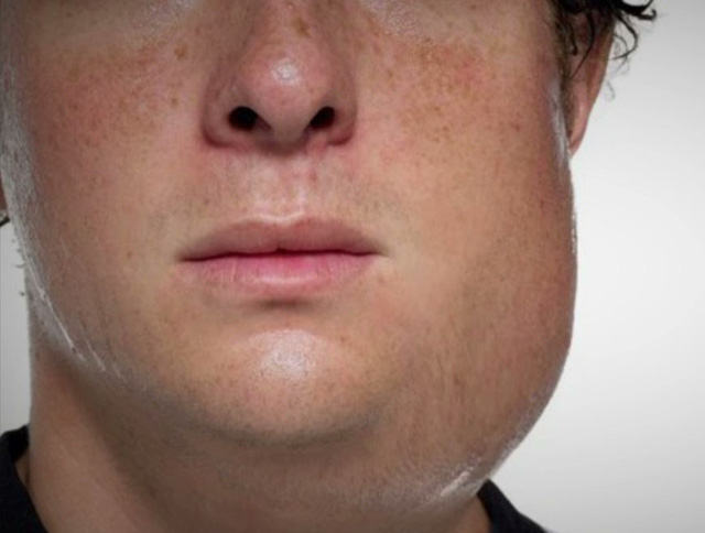 Bệnh quai bị thực chất l&agrave; tuyến nước bọt vị nhiễm virus v&agrave; sưng l&ecirc;n