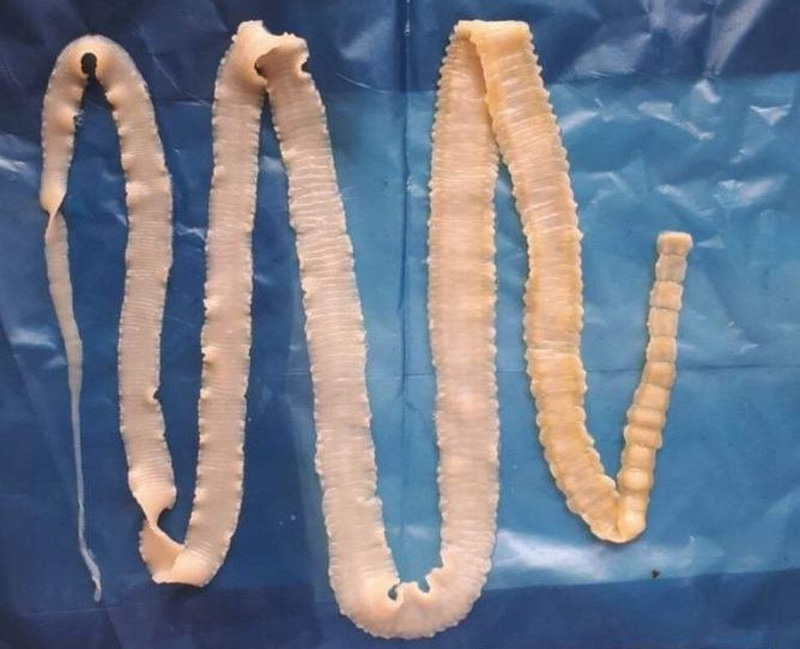 Bệnh sán lợn nguy hiểm như thế nào?