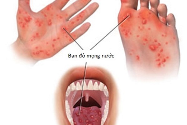 benh-tay-chan-mieng-o-tre-em