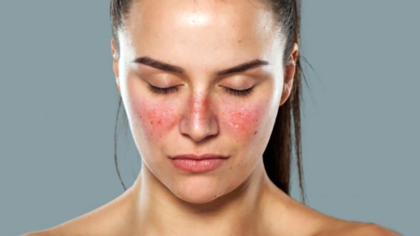 Bệnh Lupus ban đỏ được coi l&agrave; bệnh tự miễn