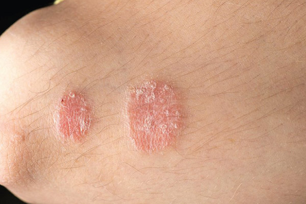 Bệnh vảy nến có chữa được không? Cách nào để phòng ngừa hiệu quả bệnh vảy nến?