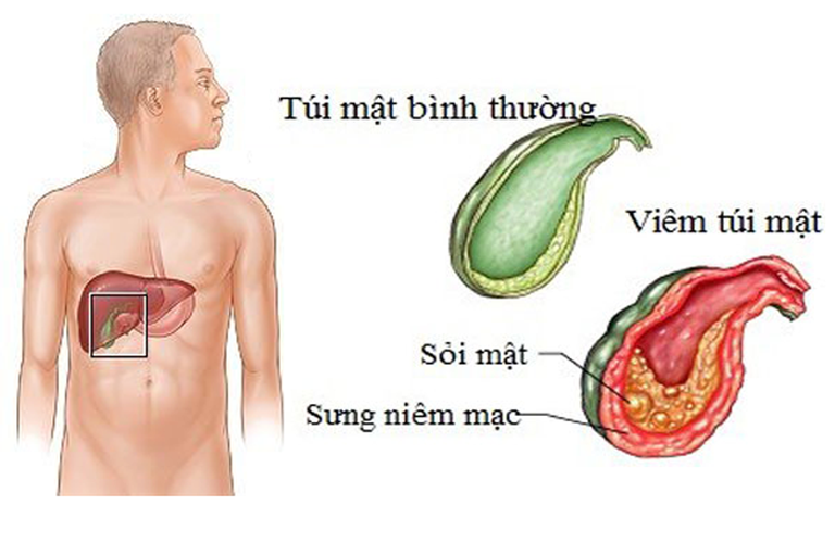 Bệnh viêm túi mật có nguy hiểm không? Điều trị viêm túi mật như thế nào?
