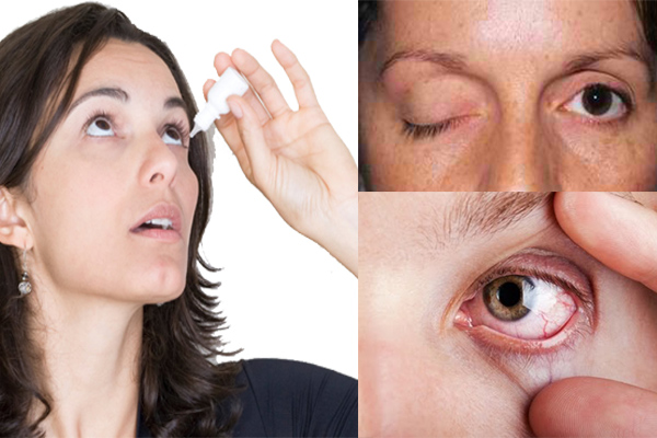 bệnh đau mắt đỏ