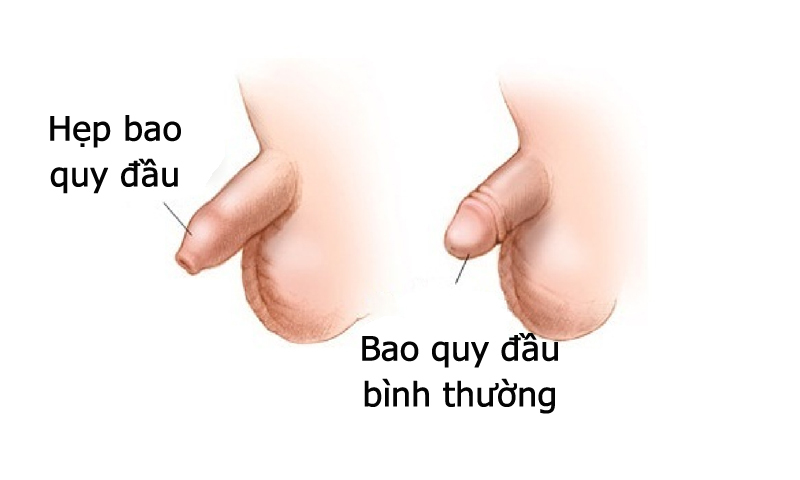 Bị hẹp bao quy đầu có nguy hiểm không? Cách chữa nào hiệu quả nhất?