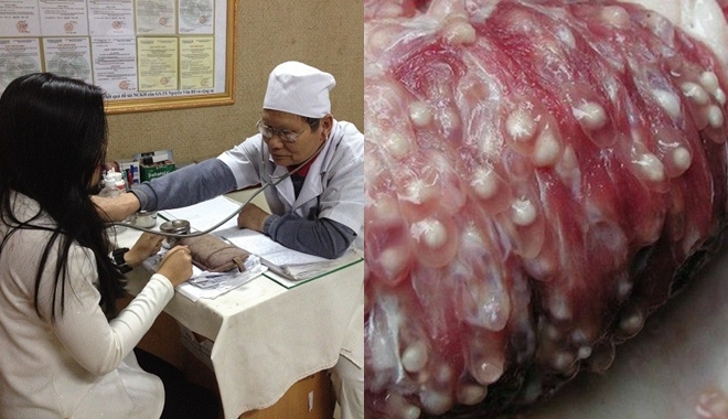 Bị nhiễm sán lợn có chữa khỏi hoàn toàn được không?