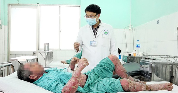 Bôi thuốc "dân tộc" vô, toàn thân sưng vù, nứt da, đóng vảy…