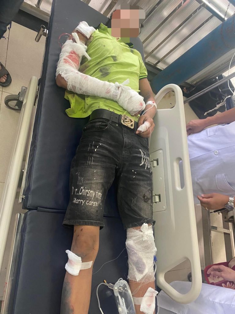 Bỏng nặng do điện thoại phát nổ khi đứng gần bếp lò