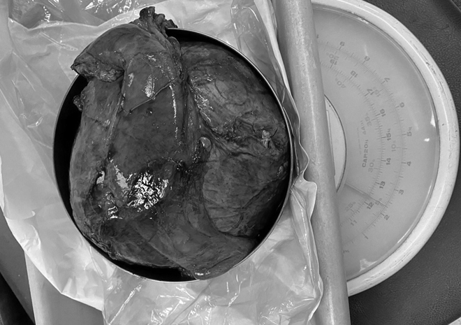 Ca mổ 10 tiếng bóc tách khối u đầu tụy "khủng" nhất thế giới