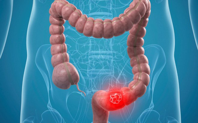 Các biện pháp được sử dụng trong điều trị bệnh viêm ruột