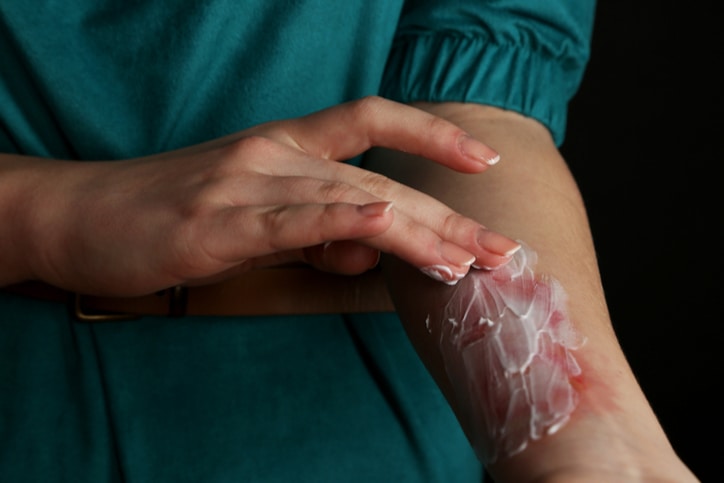 Bỏng độ 2 mất nhiều hơn ba tuần để chữa l&agrave;nh