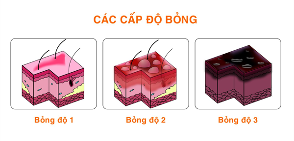 Bỏng c&oacute; 3 cấp độ