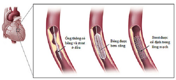 Stent phủ thuốc l&agrave; một bước tiến lớn trong ng&agrave;nh tim mạch 