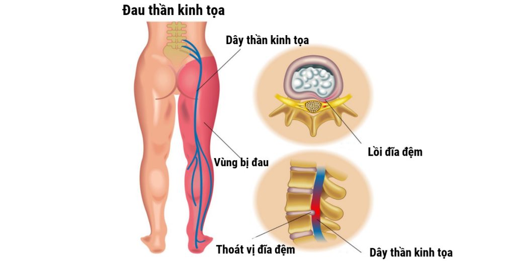 Các phương pháp điều trị hiệu quả bệnh đau thần kinh tọa
