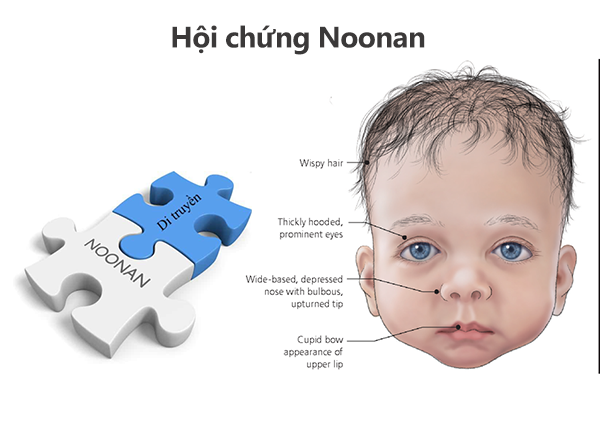 Các thông tin bạn nên biết về hội chứng Noonan