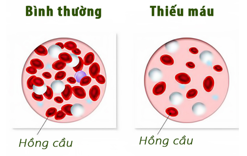 Các triệu chứng nhận biết thiếu máu là gì? Điều trị bệnh thiếu máu như thế nào?