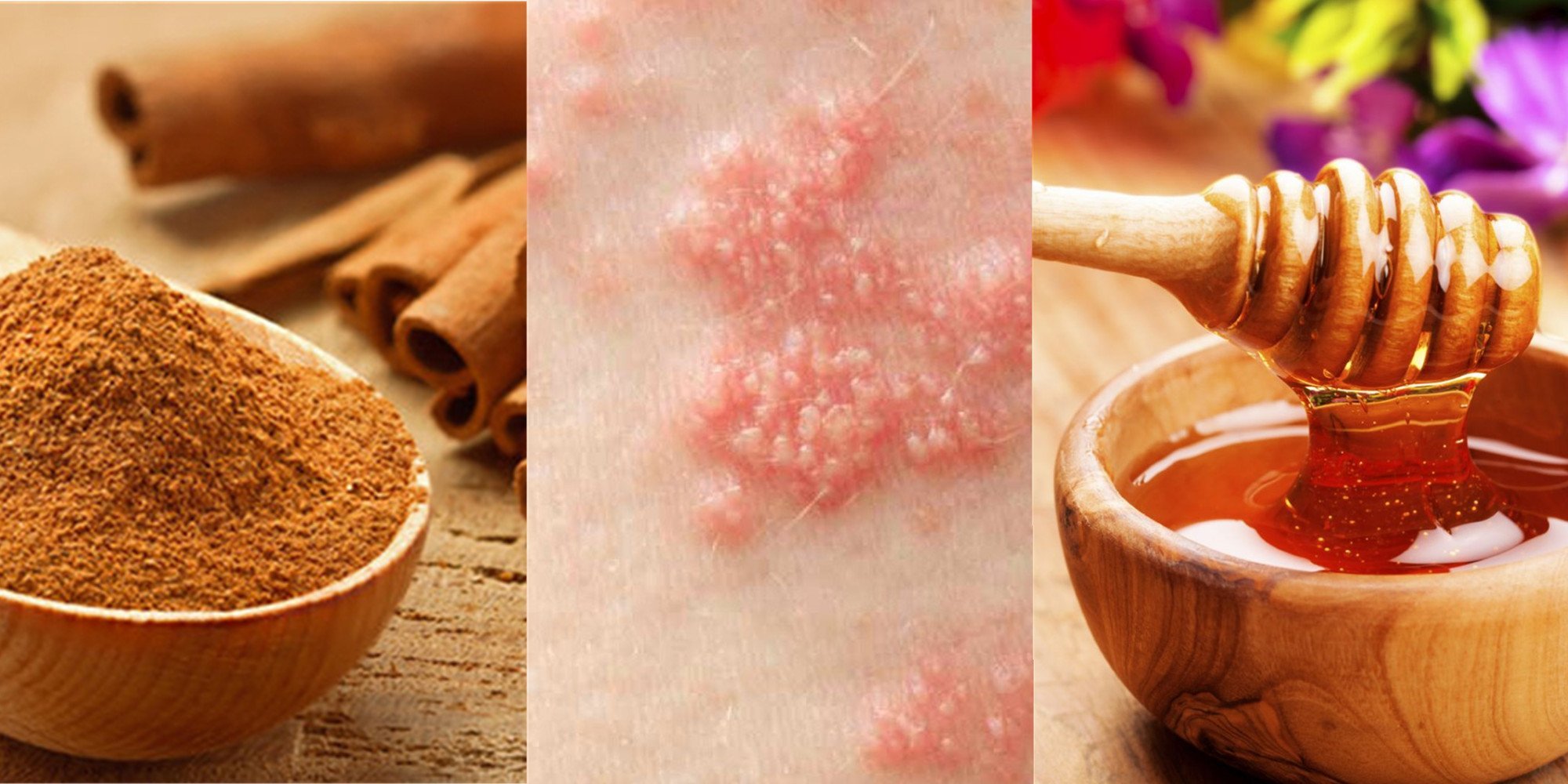 Mật ong l&agrave; một nguy&ecirc;n liệu để khử tr&ugrave;ng, chữa l&agrave;nh bị giời leo nhanh ch&oacute;ng