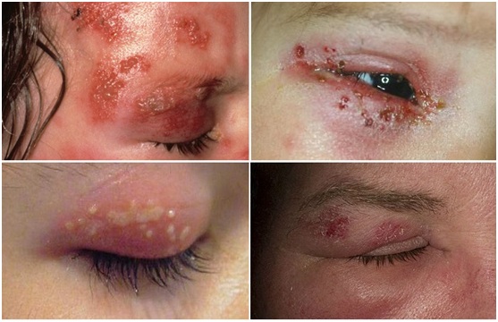 Bị bệnh giời leo người bệnh thường sẽ cảm thấy đau đớn k&egrave;m theo đau đầu, cảm c&uacute;m