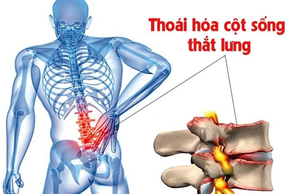 Cách điều trị thoái hóa cột sống thắt lưng hiệu quả