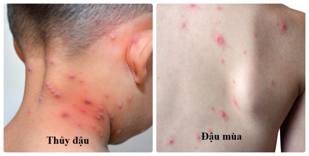 Cách phân biệt bệnh bệnh đậu mùa và thủy đậu